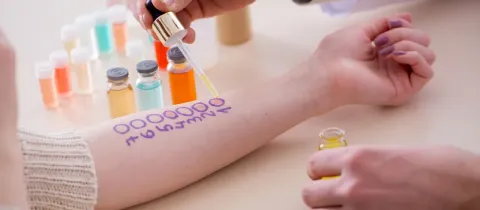 Un professionnel de la santé effectue un test cutané d'allergie sur l'avant-bras d'un patient.