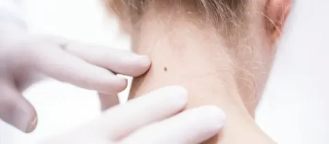 Gros plan sur un dermatologue ganté examinant un grain de beauté sur le cou d'une personne, possiblement pour le cancer de la peau.