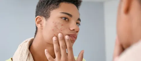 Un jeune homme examine son visage marqué par l'acné dans un miroir.