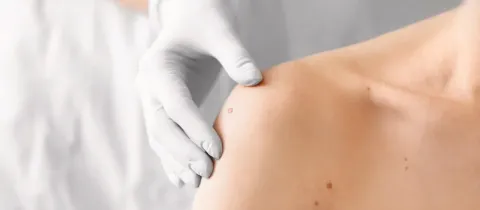 Un dermatologue examine un grain de beauté sur l'épaule d'une personne.