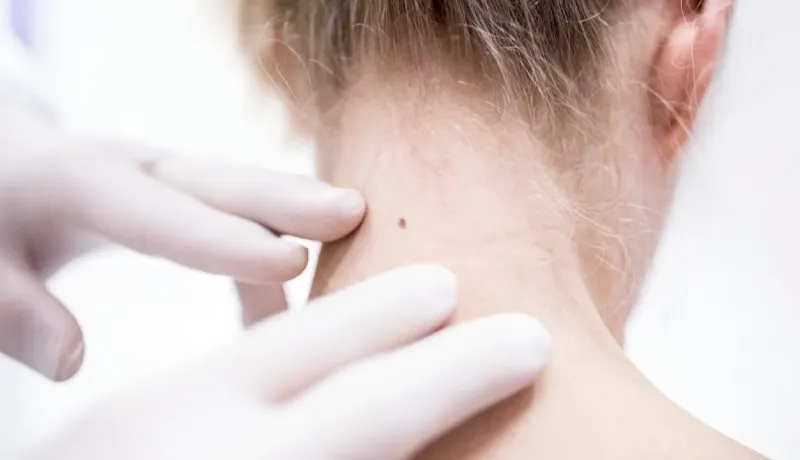 Gros plan sur un dermatologue ganté examinant un grain de beauté sur le cou d'une personne, possiblement pour le cancer de la peau.