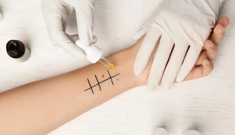 Main d'un professionnel de la santé effectuant un test cutané d'allergie sur le bras.