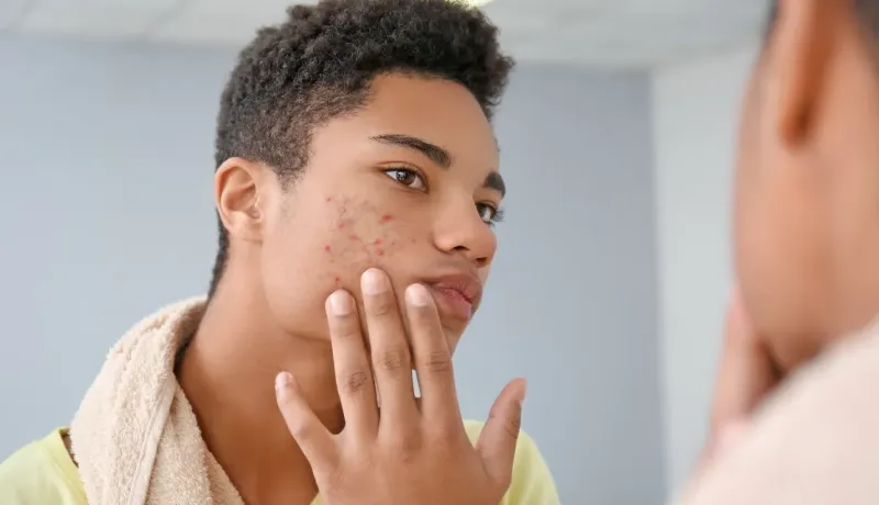Un jeune homme examine son visage marqué par l'acné dans un miroir.