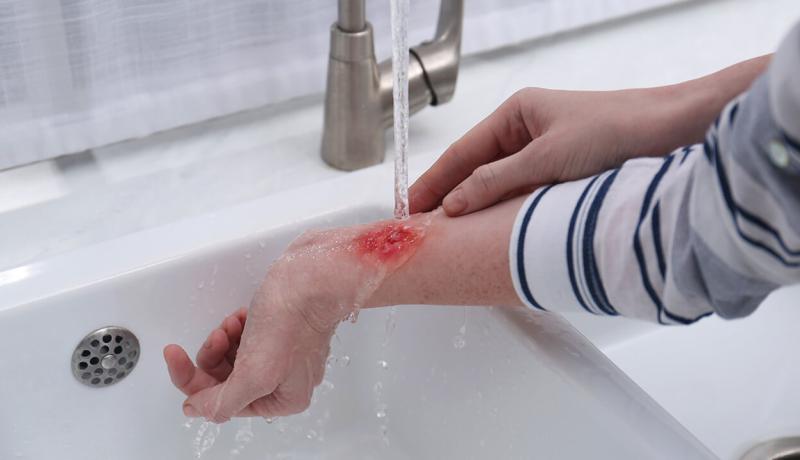 Une personne avec une brûlure passe sa main sous l'eau pour apaiser la douleur.
